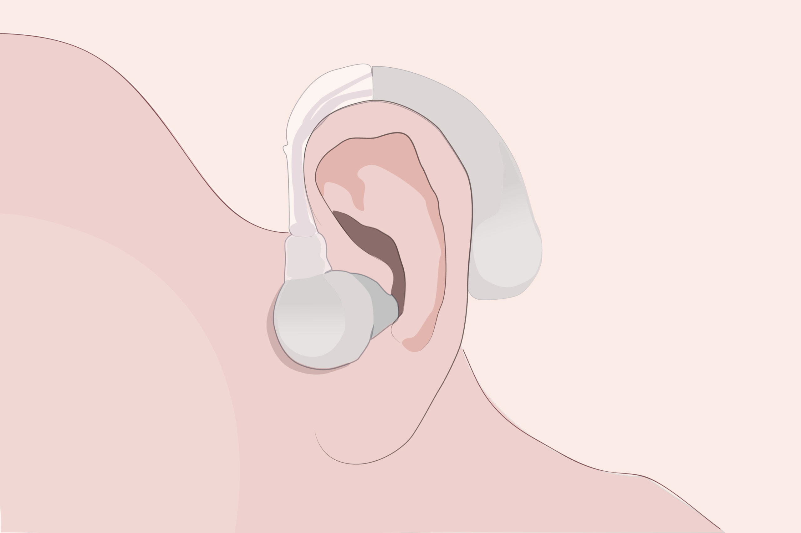 Appareillage auditif stéréophonique bilatéral : Tous les avantages